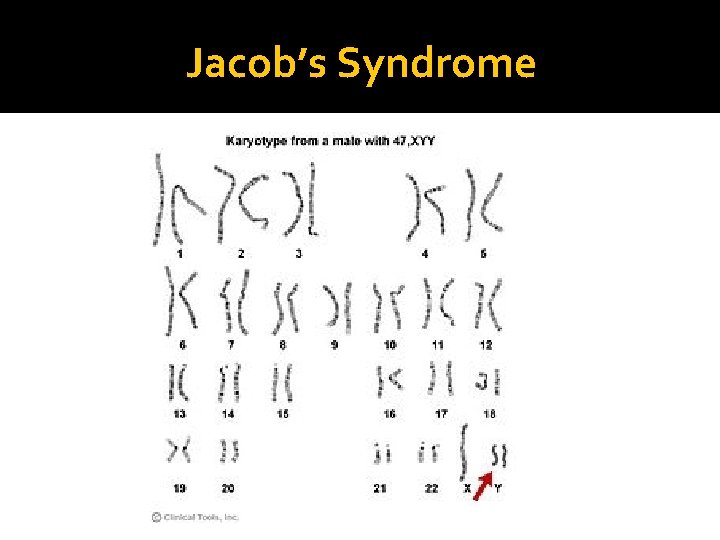 Jacob’s Syndrome Jacob’s Syndrome