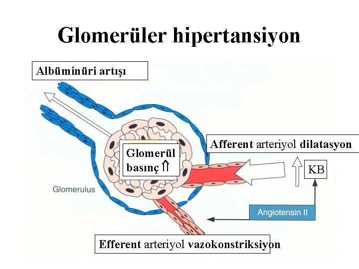 Glomerüler hipertansiyon Albüminüri artışı Glomerül basınç Afferent arteriyol dilatasyon Efferent arteriyol vazokonstriksiyon KB 