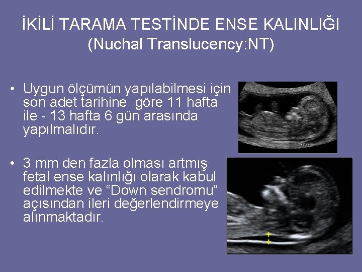 İKİLİ TARAMA TESTİNDE ENSE KALINLIĞI (Nuchal Translucency: NT) • Uygun ölçümün yapılabilmesi için son