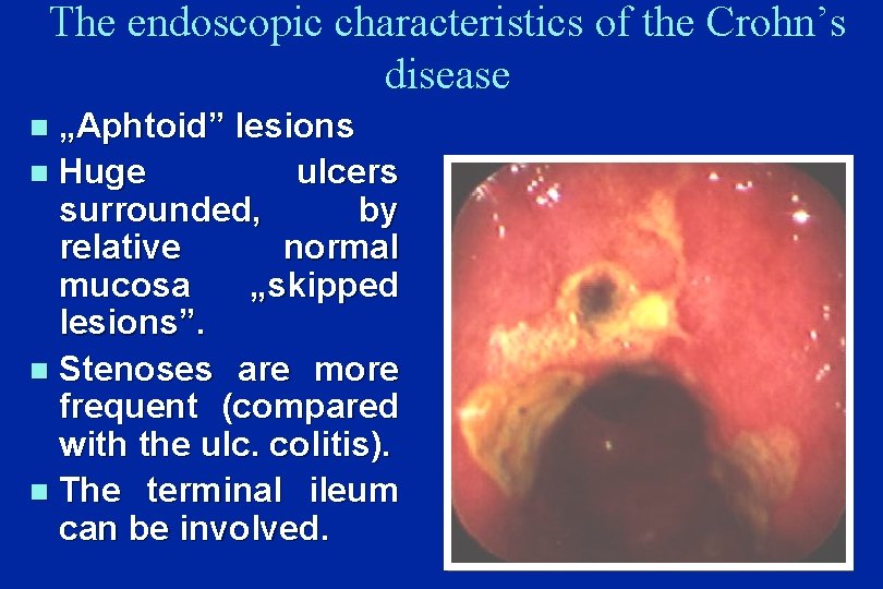 The endoscopic characteristics of the Crohn’s disease „Aphtoid” lesions n Huge ulcers surrounded, by