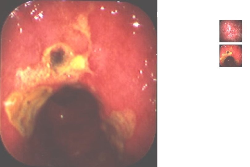 Inflammatory bowel diseases Ulcerative colitis Crohn’s disease 