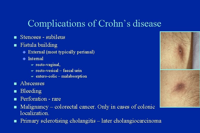 Complications of Crohn’s disease n n Stenoses - subileus Fistula building u u External