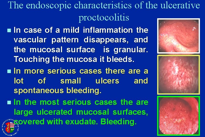 The endoscopic characteristics of the ulcerative proctocolitis In case of a mild inflammation the