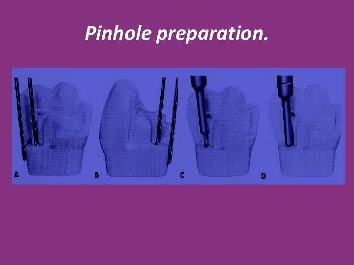 Pinhole preparation. 