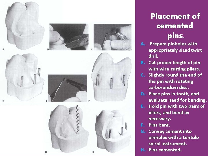 Placement of cemented pins. A. Prepare pinholes with appropriately sized twist drill. B. Cut