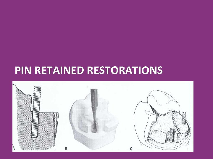 PIN RETAINED RESTORATIONS 