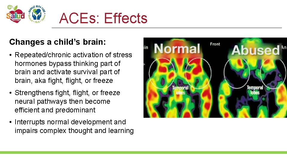 ACEs: Effects Changes a child’s brain: • Repeated/chronic activation of stress hormones bypass thinking