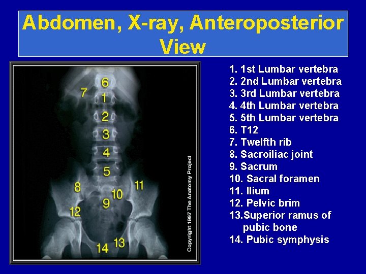 Abdomen, X-ray, Anteroposterior View 1. 1 st Lumbar vertebra 2. 2 nd Lumbar vertebra