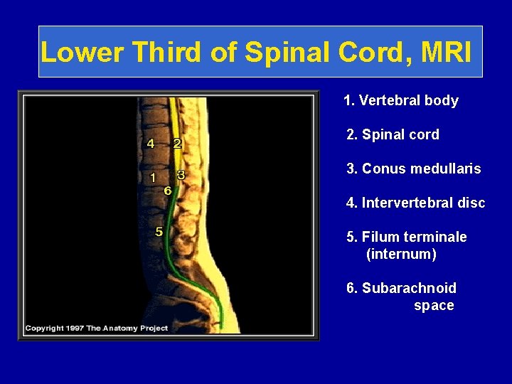 Lower Third of Spinal Cord, MRI 1. Vertebral body 2. Spinal cord 3. Conus