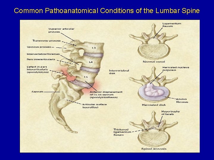 Common Pathoanatomical Conditions of the Lumbar Spine 