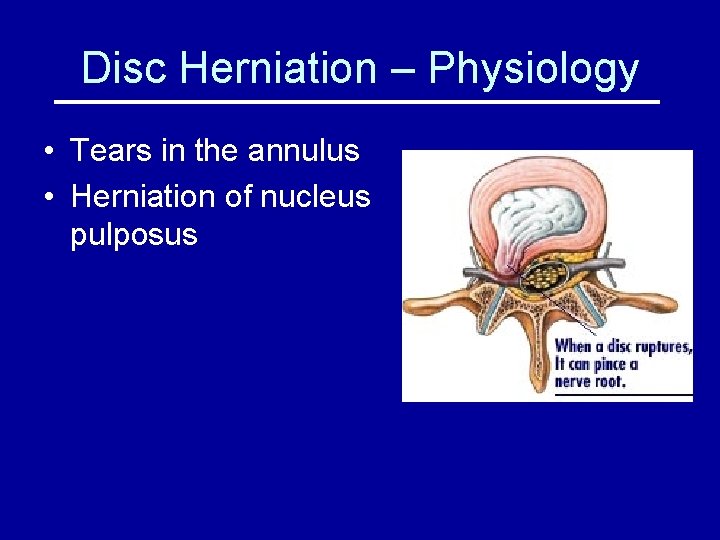 Disc Herniation – Physiology • Tears in the annulus • Herniation of nucleus pulposus