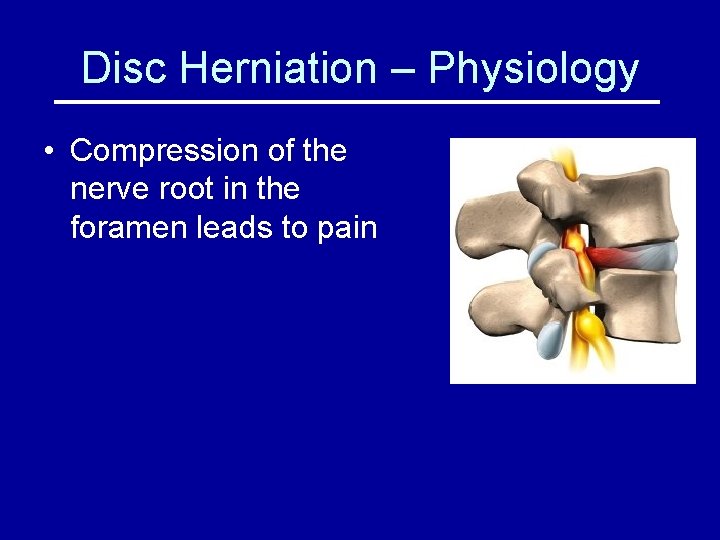Disc Herniation – Physiology • Compression of the nerve root in the foramen leads