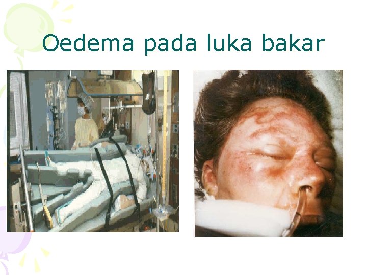 Oedema pada luka bakar 