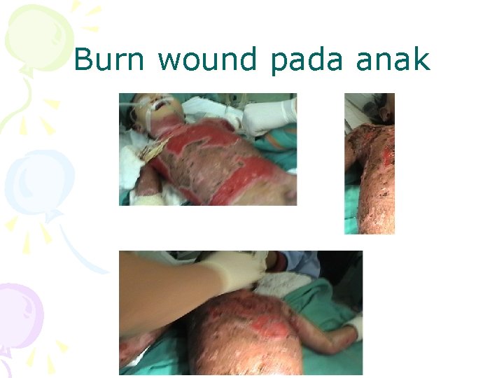 Burn wound pada anak 