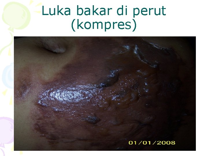 Luka bakar di perut (kompres) 