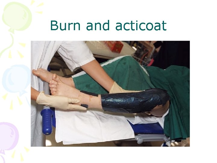 Burn and acticoat 