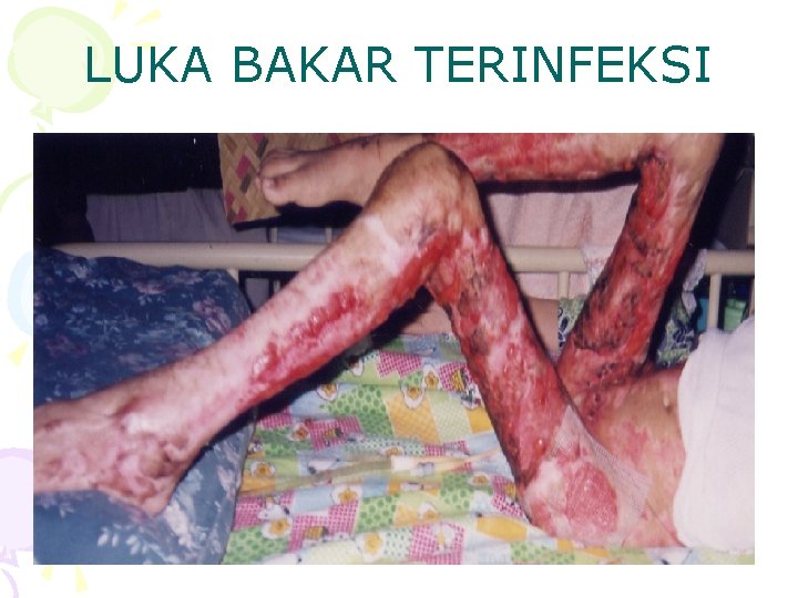 LUKA BAKAR TERINFEKSI 