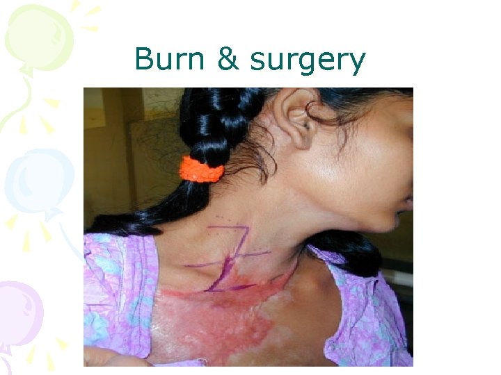Burn & surgery 