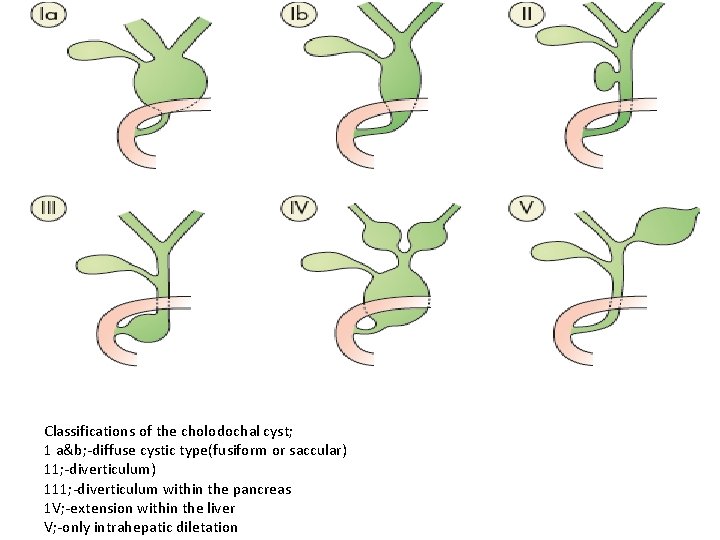 Classifications of the cholodochal cyst; 1 a&b; -diffuse cystic type(fusiform or saccular) 11; -diverticulum)