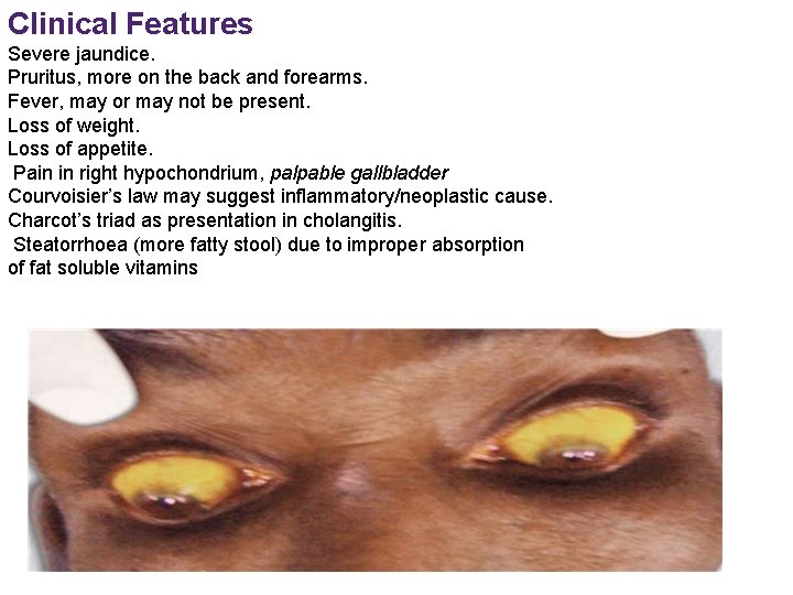 Clinical Features Severe jaundice. Pruritus, more on the back and forearms. Fever, may or