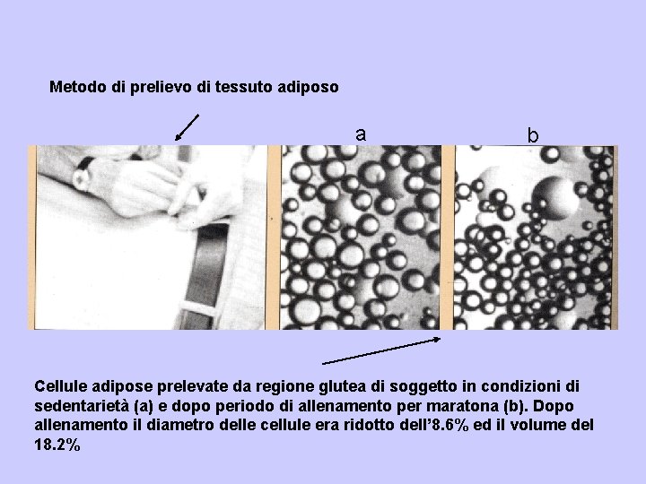 Metodo di prelievo di tessuto adiposo a b Cellule adipose prelevate da regione glutea