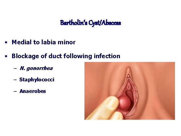 Bartholin’s Cyst/Abscess • Medial to labia minor • Blockage of duct following infection –