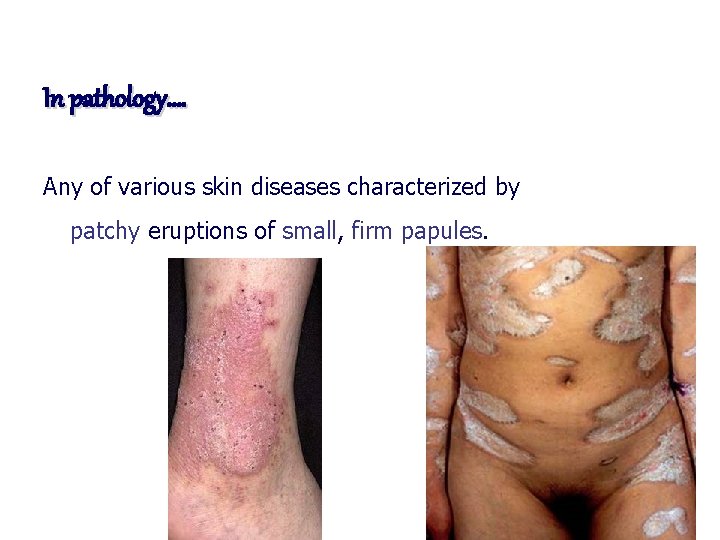 In pathology…. Any of various skin diseases characterized by patchy eruptions of small, firm