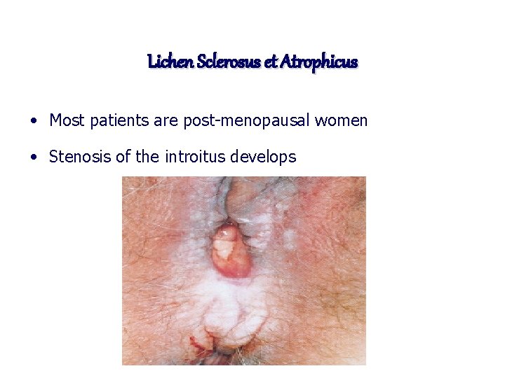 Lichen Sclerosus et Atrophicus • Most patients are post-menopausal women • Stenosis of the