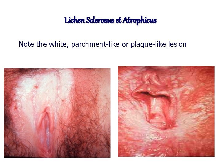 Lichen Sclerosus et Atrophicus Note the white, parchment-like or plaque-like lesion 