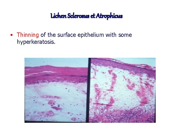 Lichen Sclerosus et Atrophicus • Thinning of the surface epithelium with some hyperkeratosis. 