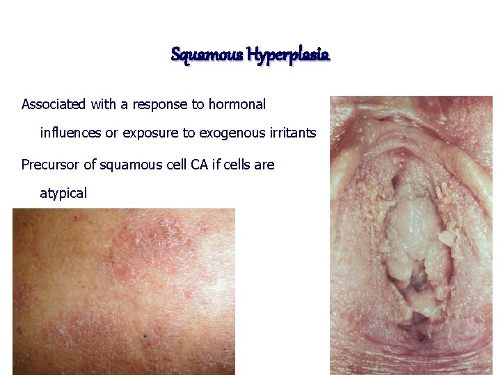 Squamous Hyperplasia Associated with a response to hormonal influences or exposure to exogenous irritants