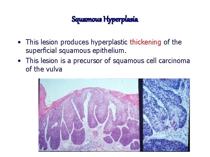 Squamous Hyperplasia • This lesion produces hyperplastic thickening of the superficial squamous epithelium. •