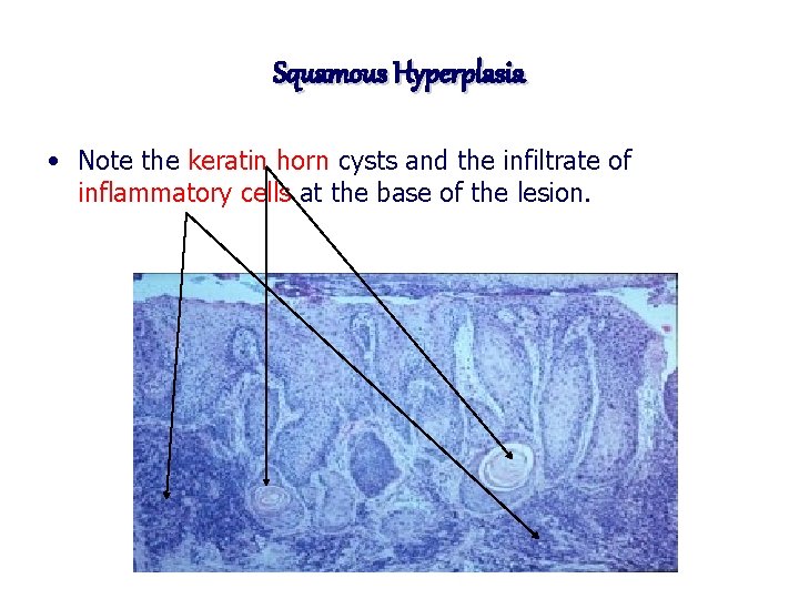 Squamous Hyperplasia • Note the keratin horn cysts and the infiltrate of inflammatory cells