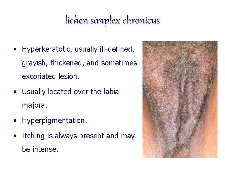 lichen simplex chronicus • Hyperkeratotic, usually ill-defined, grayish, thickened, and sometimes excoriated lesion. •