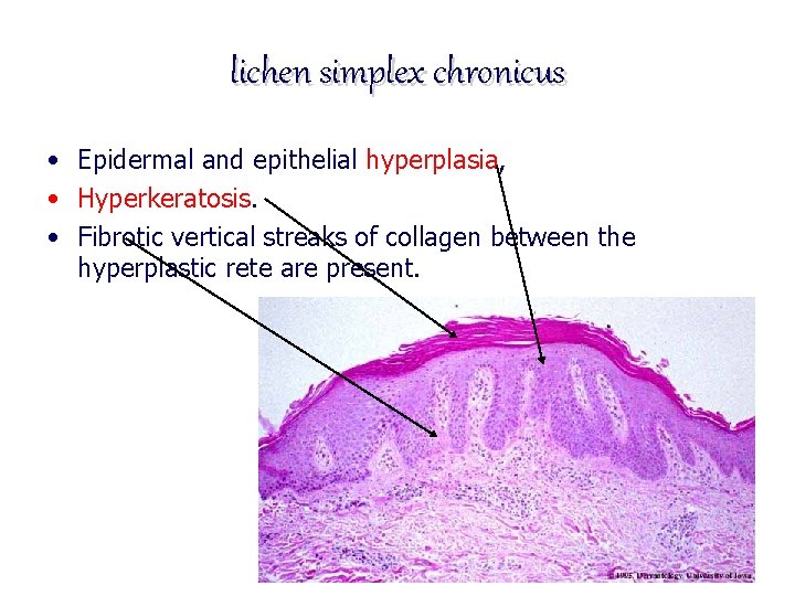 lichen simplex chronicus • Epidermal and epithelial hyperplasia, • Hyperkeratosis. • Fibrotic vertical streaks