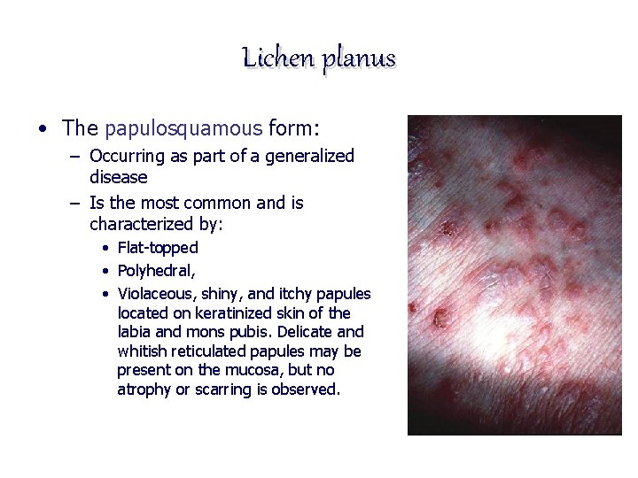 Lichen planus • The papulosquamous form: – Occurring as part of a generalized disease