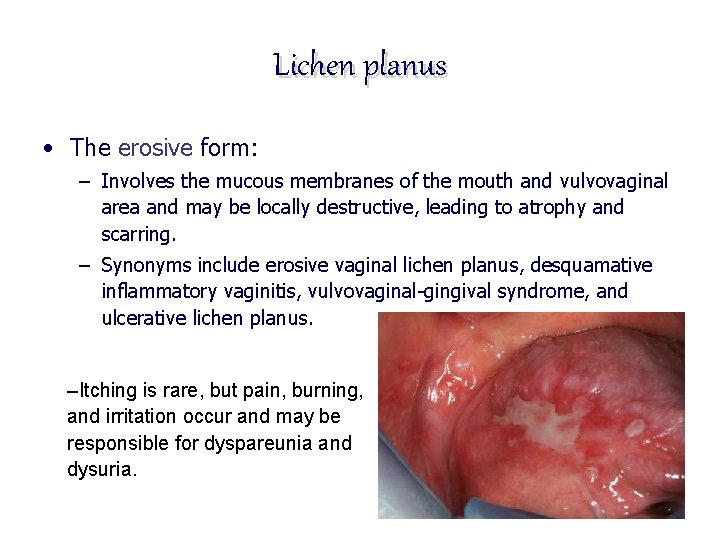 Lichen planus • The erosive form: – Involves the mucous membranes of the mouth