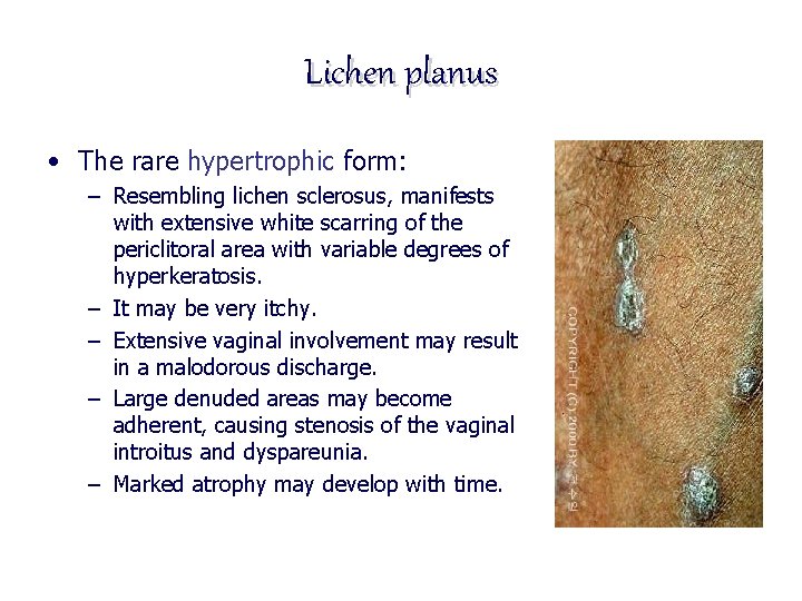 Lichen planus • The rare hypertrophic form: – Resembling lichen sclerosus, manifests with extensive