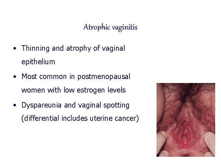 Atrophic vaginitis • Thinning and atrophy of vaginal epithelium • Most common in postmenopausal