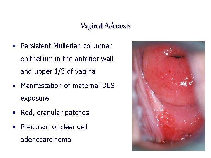 Vaginal Adenosis • Persistent Mullerian columnar epithelium in the anterior wall and upper 1/3