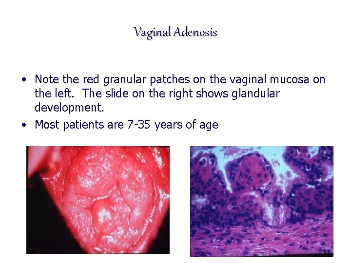 Vaginal Adenosis • Note the red granular patches on the vaginal mucosa on the