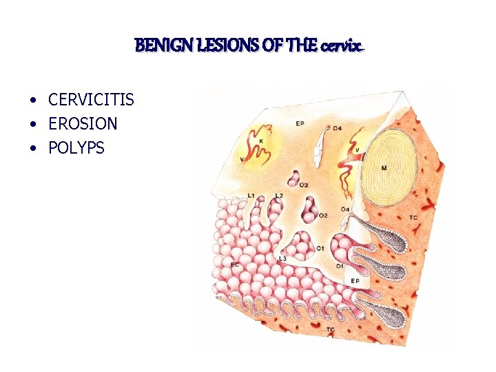 BENIGN LESIONS OF THE cervix • CERVICITIS • EROSION • POLYPS 