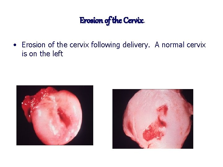 Erosion of the Cervix • Erosion of the cervix following delivery. A normal cervix