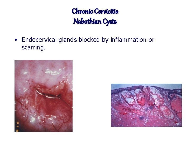 Chronic Cervicitis Nabothian Cysts • Endocervical glands blocked by inflammation or scarring. 