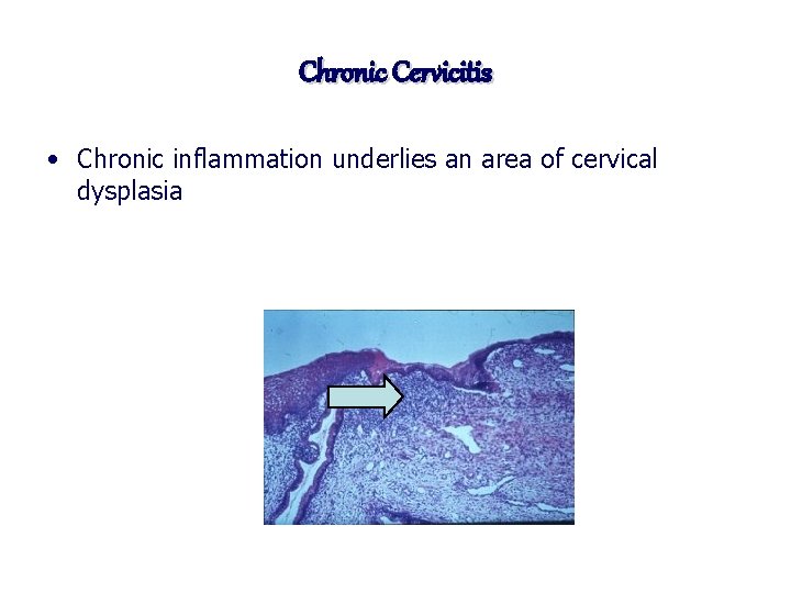 Chronic Cervicitis • Chronic inflammation underlies an area of cervical dysplasia 