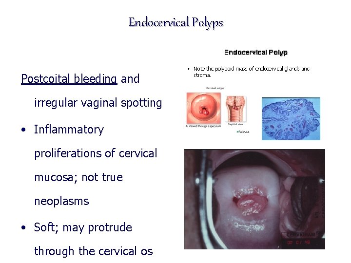 Endocervical Polyps Postcoital bleeding and irregular vaginal spotting • Inflammatory proliferations of cervical mucosa;