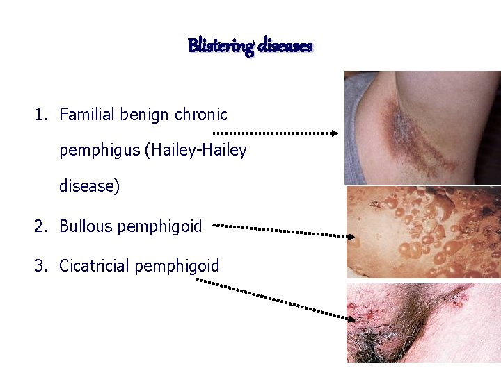 Blistering diseases 1. Familial benign chronic pemphigus (Hailey-Hailey disease) 2. Bullous pemphigoid 3. Cicatricial
