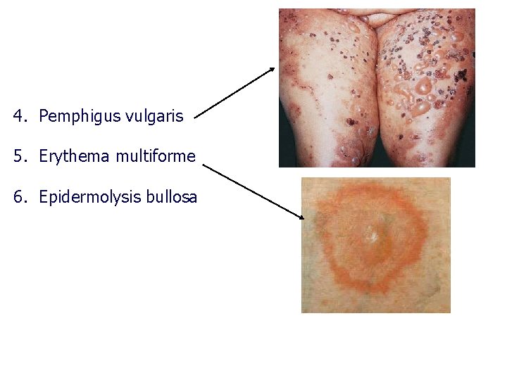 4. Pemphigus vulgaris 5. Erythema multiforme 6. Epidermolysis bullosa 