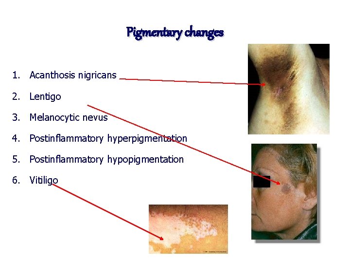 Pigmentary changes 1. Acanthosis nigricans 2. Lentigo 3. Melanocytic nevus 4. Postinflammatory hyperpigmentation 5.
