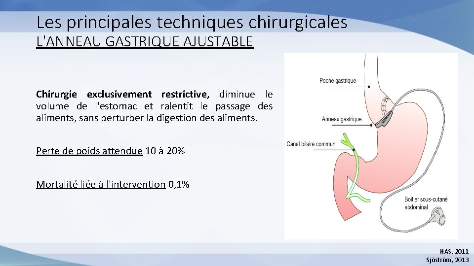 Les principales techniques chirurgicales L'ANNEAU GASTRIQUE AJUSTABLE Chirurgie exclusivement restrictive, diminue le volume de